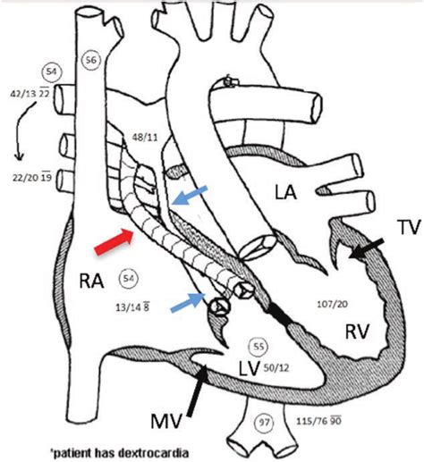 lv to pa conduit|post right ventricular valve conduit.